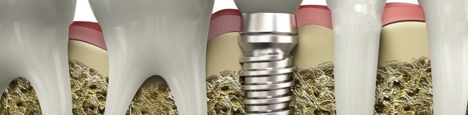 why dental implants may be a better option than dentures
