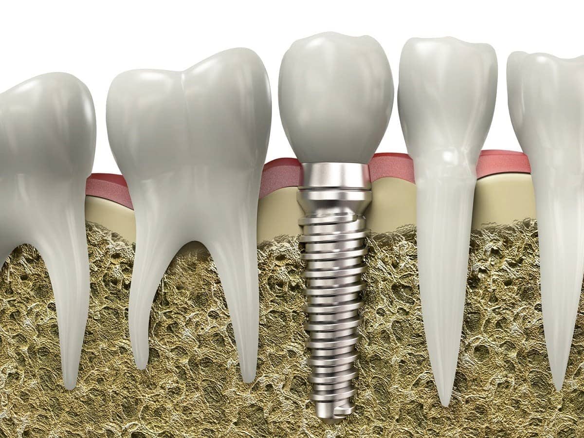 why dental implants may be a better option than dentures
