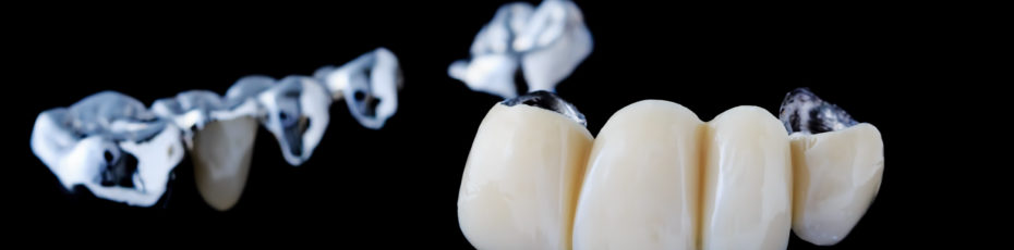 the four types of dental bridges