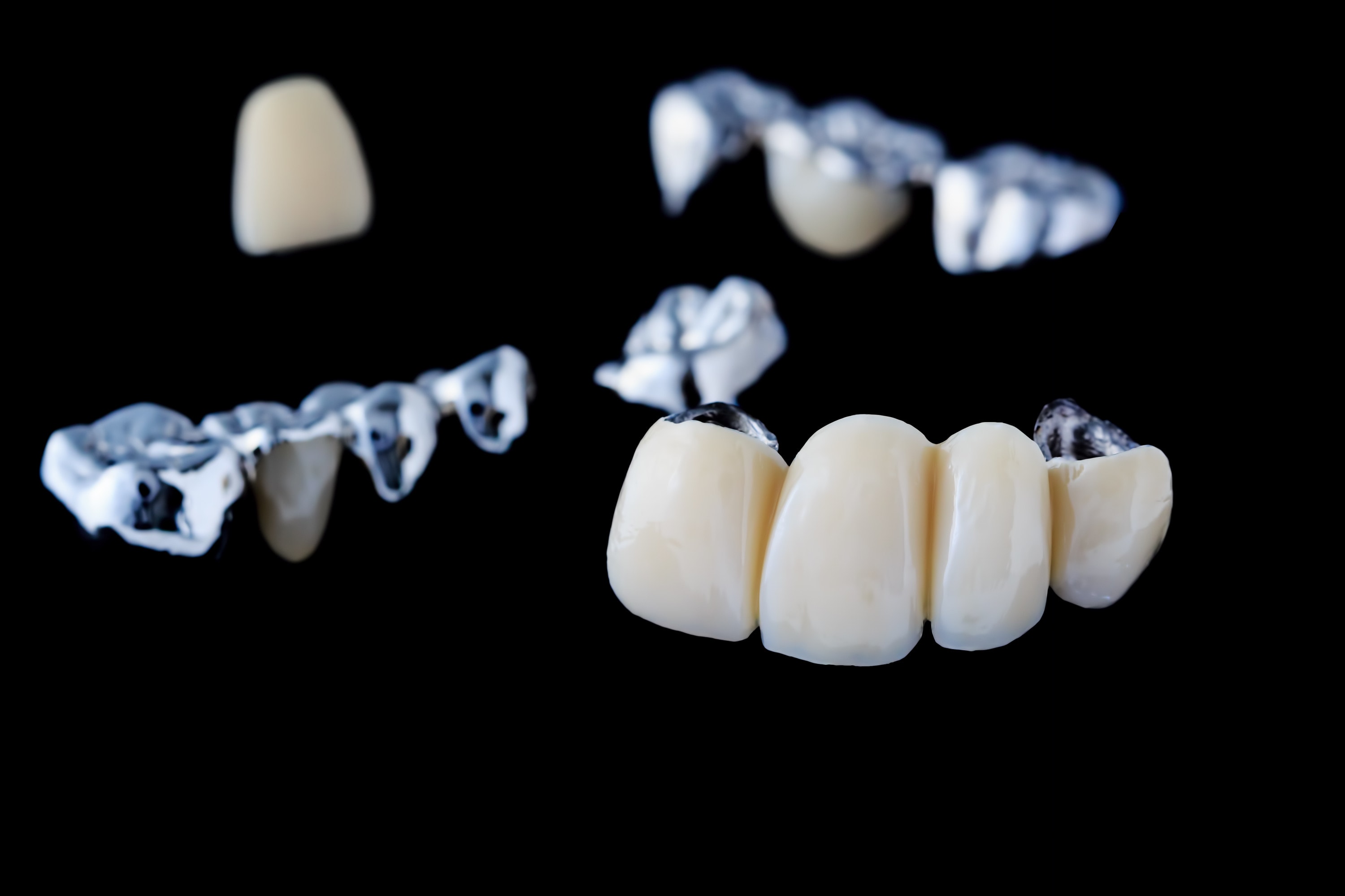 the four types of dental bridges