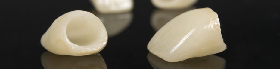 five ways to protect your dental crowns