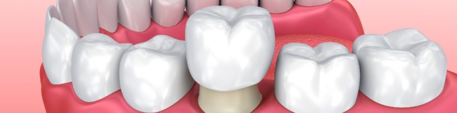 what to do when your dental crown falls out