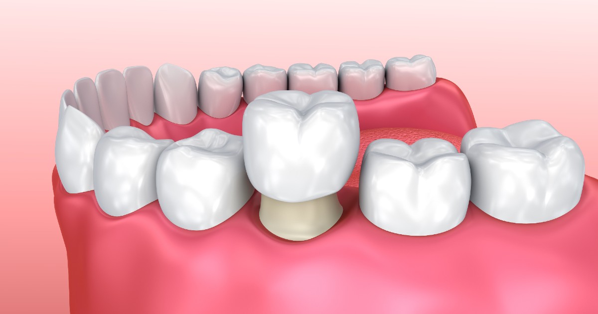 what to do when your dental crown falls out