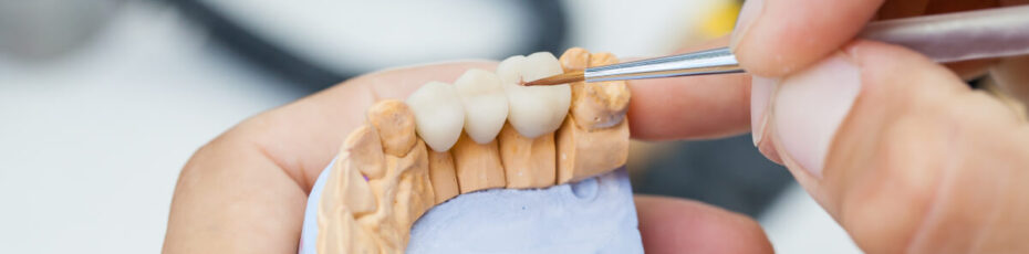 are dental bridges a good tooth replacement option
