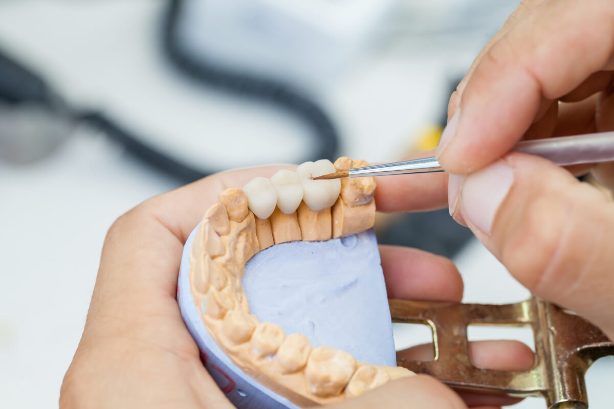 are dental bridges a good tooth replacement option