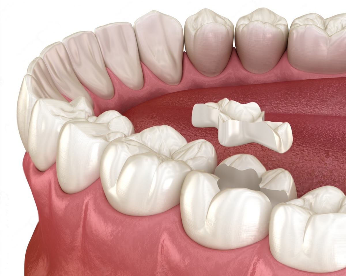 why porcelain inlays and onlays are the perfect solution for restoring damaged teeth