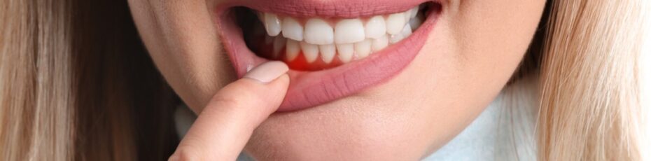 why your gums bleed when brushing