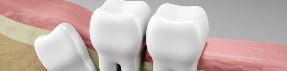 age do wisdom teeth usually emerge